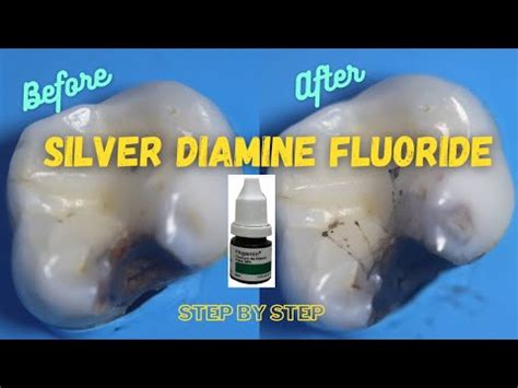 Fagam N Fluoruro Diamino Plata Dental Ml Santiago Cuotas Sin Inter S