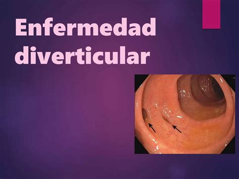 Enfermedad Diverticular Ppt Descarga Gratuita