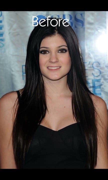 Kylie Jenner Before And After Plastic Surgeriesshortsfeedshorts Modelshortsbeta