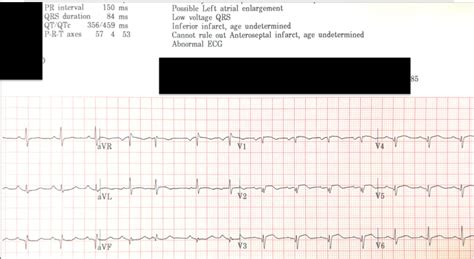 Dr. Smith's ECG Blog: Anterorlateral STEMI? Old Anterior MI? But cath shows RCA thrombotic stenosis.