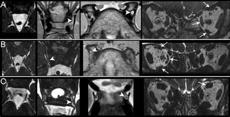 MRI findings in patients 4 (A), 5 (B), and 6 (C) — distal nerve ...