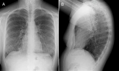 Reading The Chest X Ray Chest Radiography Identifying A Normal Chest