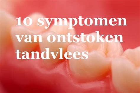 Bloedend Tandvlees 10 Tips Oorzaken En Behandeling