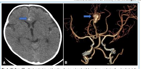 Figure 1 From Successful Endovascular Management Of An Unruptured