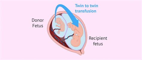 Twin to twin transfusion syndrome (TTFS)