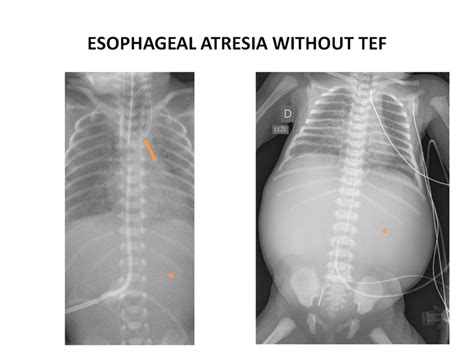 Xr Of Two Infants With Esophageal Atresia Without Traheoesophageal