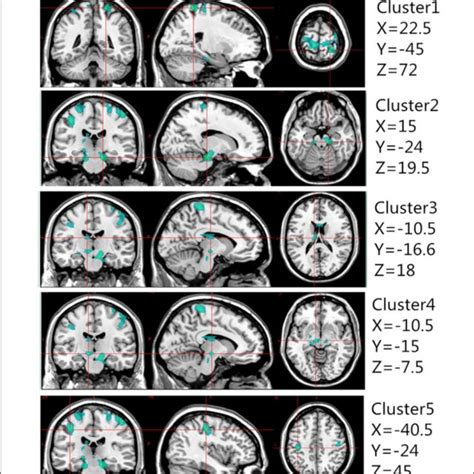 FIGURE Gray Matter Volume Decreased In Specific Cerebral Areas In The