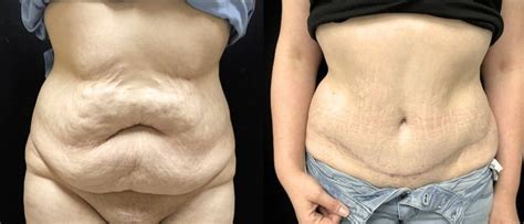 Combien Coute Une Abdominoplastie Alucare