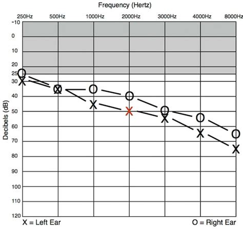 Understanding Hearing Loss Deaf Education