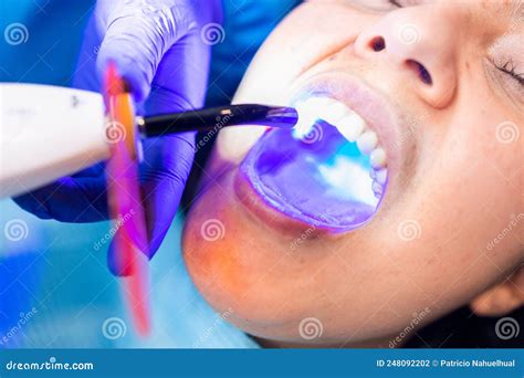 Tooth Restoration With Filling And Polymerization Lamp Dental Curing