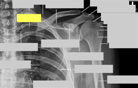 CL XRAY Shoulder Elbow Forearm Wrist Flashcards Quizlet