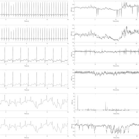 Proposed Method Applied To Real Ecg Signals A Denoising Of The