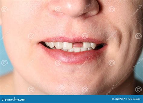 Sourire Sans Dent Avant Image Stock Image Du Clinique 49287367