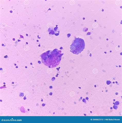 Ascitic Fluid Cytology Leishman Stain Smear Show Lymphocytes