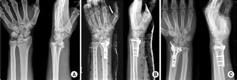 67 Year Old Woman With Unstable Distal Radius Fracture Was Treated By