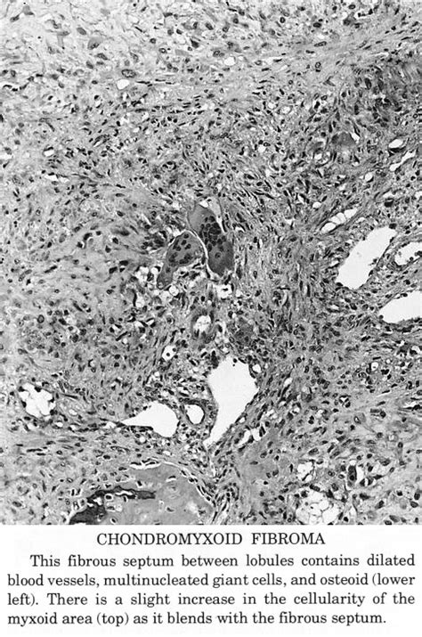 Pathology Outlines Chondromyxoid Fibroma