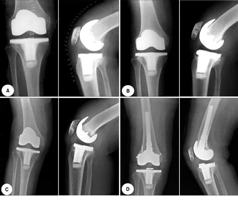 Table 1 From Total Knee Arthroplasty With NexGen R System 3 8 Year