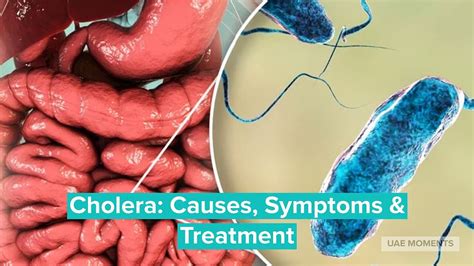 Cholera Symptoms And Causes