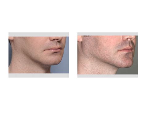 Plastic Surgery Case Study Four Piece Total Jawline Augmentation