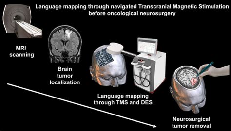 Jpm Free Full Text Preoperative Navigated Transcranial Magnetic