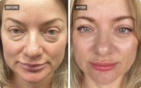 Lower Blepharoplasty Gone Wrong