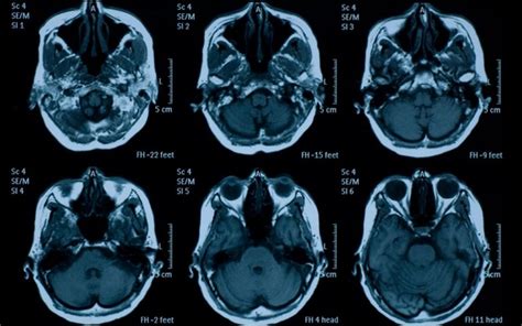 Leucoaraiose Et Facteurs De Risque Cardio Vasculaires Dousopal