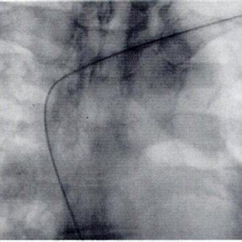 -Placement of Hickman catheter. A and B, Line drawing (A) and ...