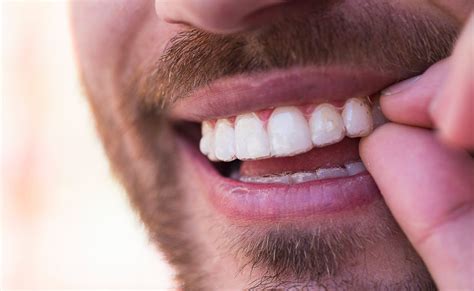 Ataches Invisalign Qué son y para qué sirven