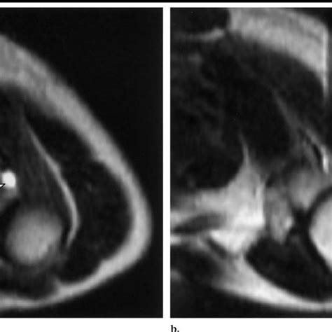 transverse fast spin echo  images  demonstrate