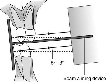 10: Bitewing radiography | Pocket Dentistry