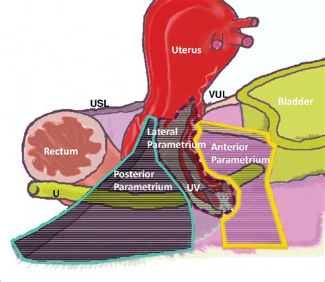 Mri Anatomy Of Parametrial Extension To Better Identify Local Pathways