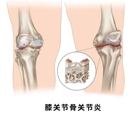 健康科普 且行且珍膝——膝关节炎科普 知乎