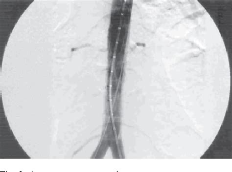 Figure From A Case Report Of Endovascular Stenting In Salmonella