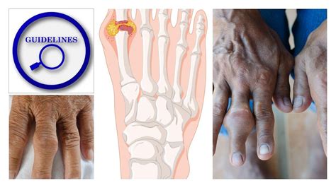 The 2020 Treatment Guidelines for Gout | Rheumatology Network