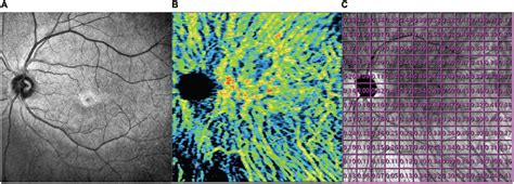 Example Of A Slo Image A Choroidal Vascularity Index Image Middle Download Scientific