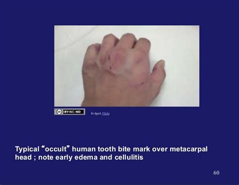 Gemc Mammal And Human Bite Injuries