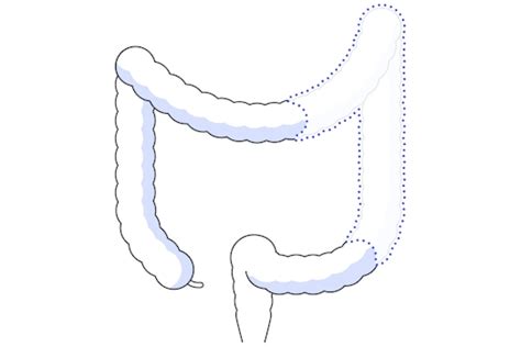 Da Vinci Surgery Colectomy Robotic Assisted Surgery