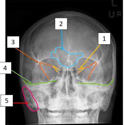 PA Axial Caldwell Cranial Bones Diagram Quizlet