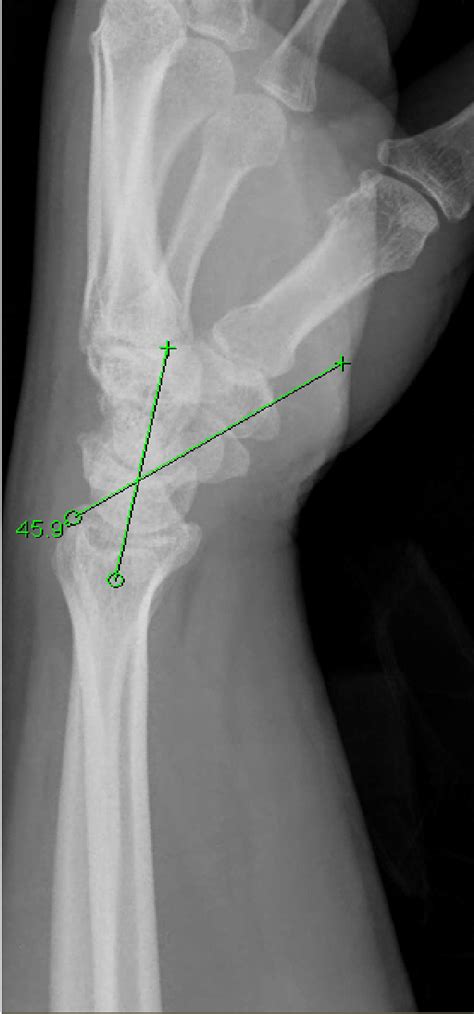 Measurement Of Scapholunate Angle 3 Ulnar Variance Figure 3 A Line