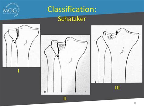 Schatzker Fracture Classification