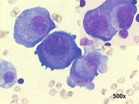 Malignant Mesothelioma Diagnosis