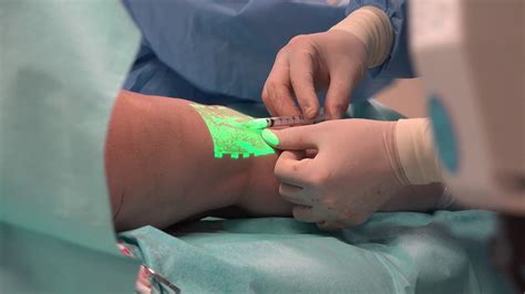 Sclerotherapy Ultrasound Guided Treatment The Vein Institute