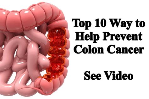 Top 10 Ways To Help Prevent Colon Cancer Dr Paul Haider Award