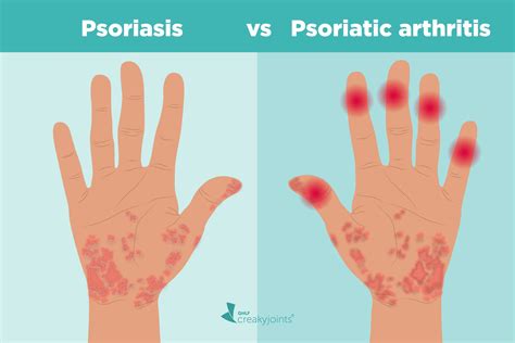 Psoriasis And Psoriatic Arthritis Whats The Connection