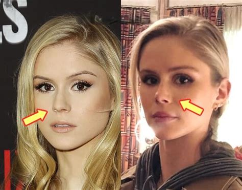 Erin Moriarty Plastic Surgery Analysis And Expert Opinion