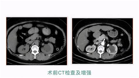 我院泌尿外科成功開展首例輸尿管軟鏡下鈥雷射腎盂旁囊腫內切開術 每日頭條