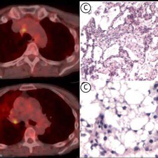 In A Axial Ct Scans Of The Chest Showing A Crazy Paving Pattern In The