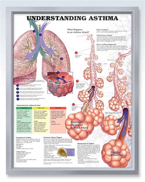 Understanding Asthma Chart 20×26 Artofit