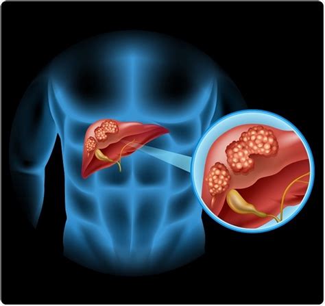 Documento Internacional De Consenso Sobre Cáncer De Las Vías Biliares