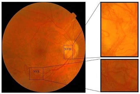 Proliferative Diabetic Retinopathy Diagnosis Using Varying-Scales